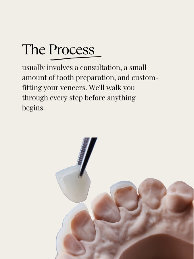 The veneer process: consultation, a small amount of tooth preparation, and custom fitting, explained by FB Dental
